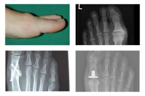 Hallux Rigidus (stiff big toe)